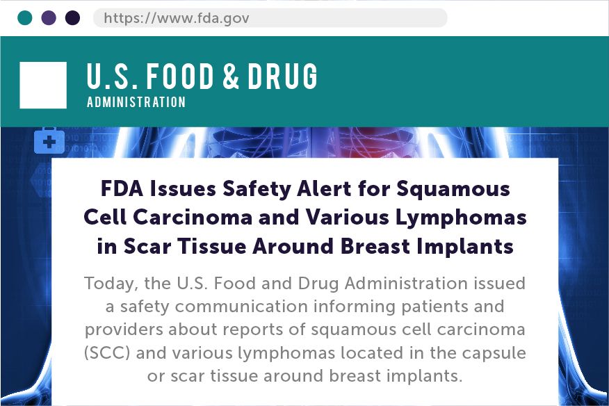 Illustration of a website article, with the website title: U.S Food & Drug Administration. The headline of the article is: FDA Issues Safety Alert for Squamous Cell Carcinoma and Various Lymphomas in Scar Tissue around Breast Implants.